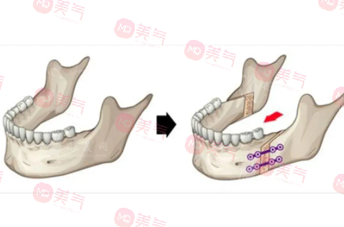上海九院正頜手術(shù)費(fèi)用揭秘，快速了解報銷標(biāo)準(zhǔn)，省錢又安心！