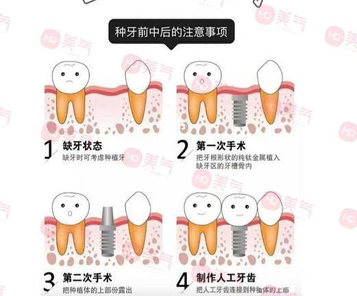 上海種植牙價格表大全更新！低至5900？內附種植牙原理、注意事項