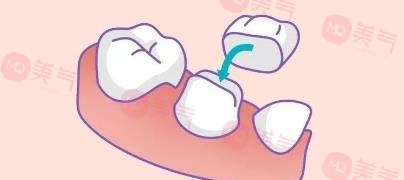 補(bǔ)一顆烤瓷牙多少錢？較多的價(jià)格因素影響你了解幾個(gè)？