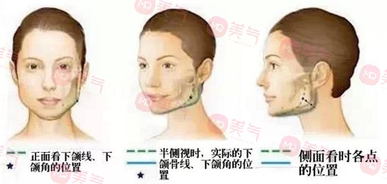 北京八大處頜面外科哪個(gè)大夫好？張智勇醫(yī)生-下頜角案例圖反饋