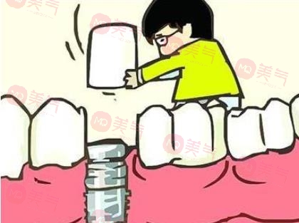 上海種植牙價格表大全更新！低至5900？內附種植牙原理、注意事項