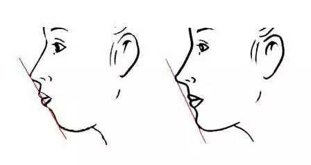 凸嘴改善介紹,效果、價(jià)格和優(yōu)缺點(diǎn)是什么？