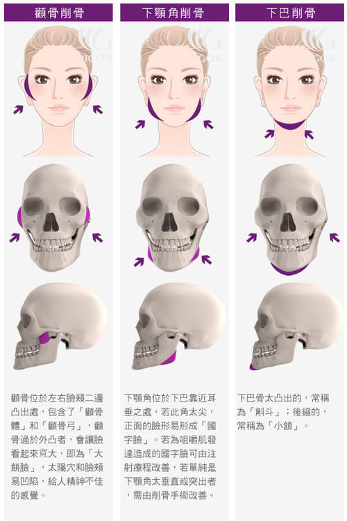 下顎前凸項(xiàng)目介紹,價(jià)格是多少？附案例展示