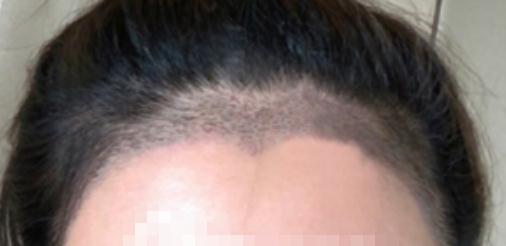 新疆整形美容醫(yī)院植發(fā)案例