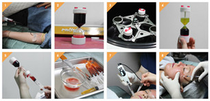 自體血清美膚真的有嗎?項(xiàng)目簡(jiǎn)介_真實(shí)案例_優(yōu)缺點(diǎn)介紹