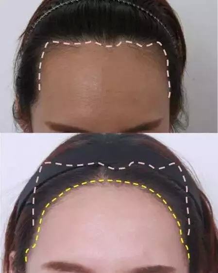 植發(fā)際線效果怎么樣？多少錢？簡介和優(yōu)缺點(diǎn)盤點(diǎn)