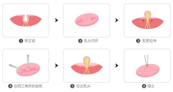 乳頭凹陷矯正多少錢？效果怎么樣？簡(jiǎn)介和優(yōu)缺點(diǎn)盤點(diǎn)