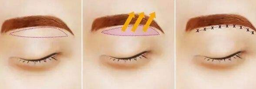 切眉術(shù)介紹,效果、價(jià)格和優(yōu)缺點(diǎn)是什么？