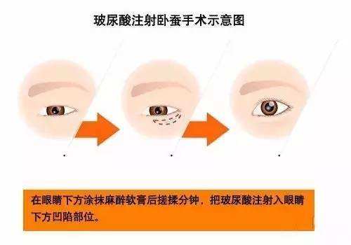 玻尿酸填臥蠶效果好不好？要多少錢？項(xiàng)目介紹和優(yōu)缺點(diǎn)盤點(diǎn)