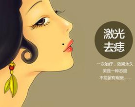 激光點(diǎn)痣