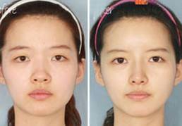 寬鼻梁矯正術(shù)真的有嗎?項(xiàng)目簡(jiǎn)介_(kāi)真實(shí)案例_優(yōu)缺點(diǎn)介紹