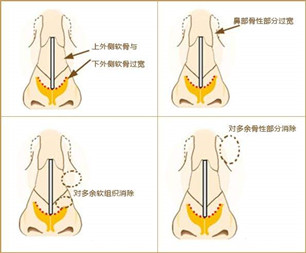 寬鼻梁矯正術(shù)真的有嗎?項(xiàng)目簡(jiǎn)介_(kāi)真實(shí)案例_優(yōu)缺點(diǎn)介紹