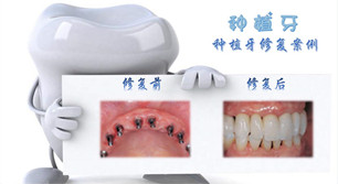 全口種植牙恢復(fù)期是多久?項(xiàng)目簡(jiǎn)介_(kāi)真實(shí)案例_優(yōu)缺點(diǎn)介紹