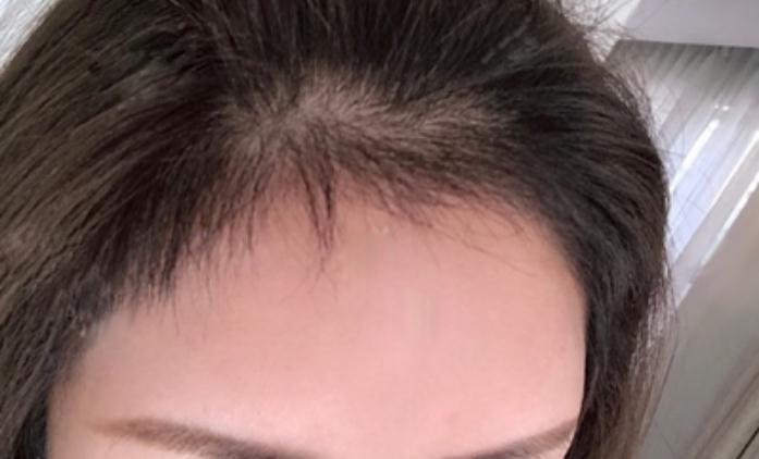 新疆整形美容醫(yī)院植發(fā)案例