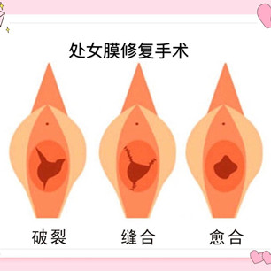 處女膜修復