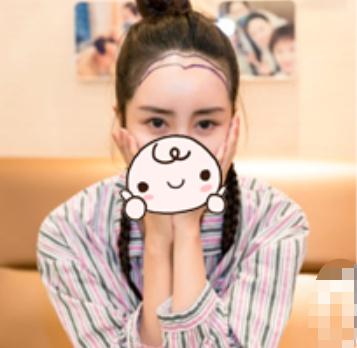 新疆整形美容醫(yī)院植發(fā)案例