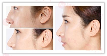 駝峰鼻治療有哪些方法？如何有效治療駝峰鼻？