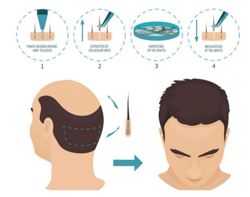 廣州倍生植發(fā)醫(yī)院技術(shù)如何？選對(duì)醫(yī)院不再為禿頭煩惱！
