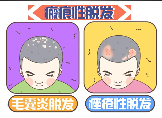 廣州倍生植發(fā)醫(yī)院技術(shù)如何？選對(duì)醫(yī)院不再為禿頭煩惱！