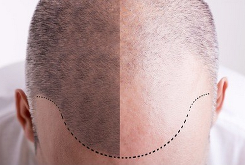 廣州首瑞植發(fā)口碑好嗎？有你青睞的發(fā)際線種植醫(yī)生嗎？