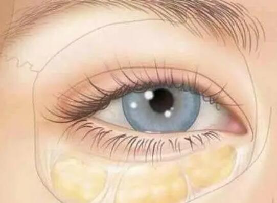 脂肪填充淚溝有哪些注意事項？關(guān)于脂肪填充你了解多少？