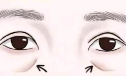 填充淚溝選擇自體脂肪還是玻尿酸好？一般可以維持多長時間？