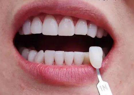 全部牙齒貼面的價格是多少？選擇材料不同相差價格較大！