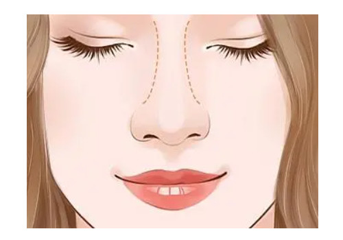隆鼻6.jpg