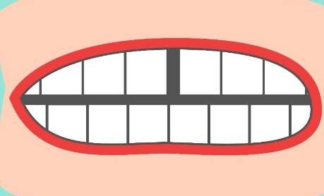 牙縫大了怎么補救？常見的修復方式就是貼面修復，正畸矯正，牙冠修復等