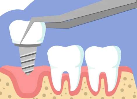 全口種牙價(jià)格是多少錢(qián)？通常情況下需要4萬(wàn)元到15萬(wàn)元之間