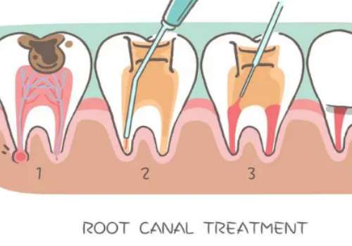 深圳牙齒矯正大概要花費多少錢？一般8000元起，具體的費用與矯正方式、醫(yī)院等級有密切的聯(lián)系