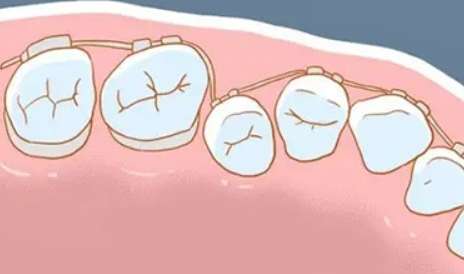 糾正牙齒需要多少錢費用？需要1萬元到5萬元之間，具體的價格要根據(jù)當?shù)氐南M水平