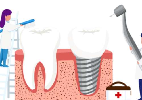 門牙種植的全部過程是什么？過程有口腔檢查、手術(shù)麻醉、種植人工牙根、等待骨結(jié)合期、牙冠修復(fù)等