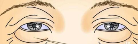 去眼袋動(dòng)漫28.jpg