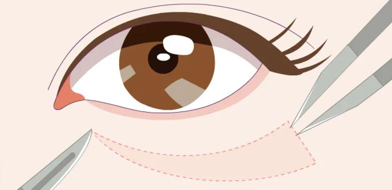 去眼袋動漫12.jpg 去眼袋動漫12.jpg