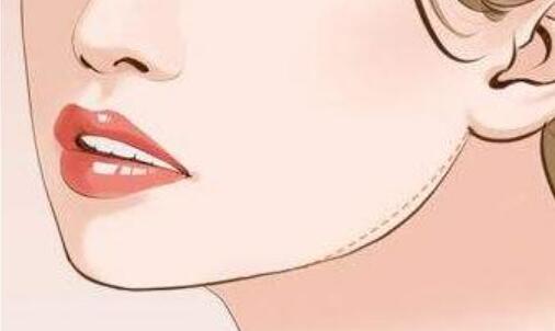 l下頜角q2.jpg l下頜角q2.jpg