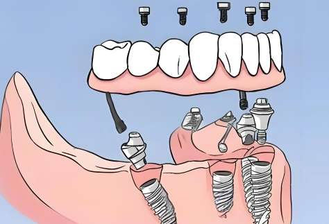 種植牙的報價公布！一顆大約是在4000元都15,000元之間