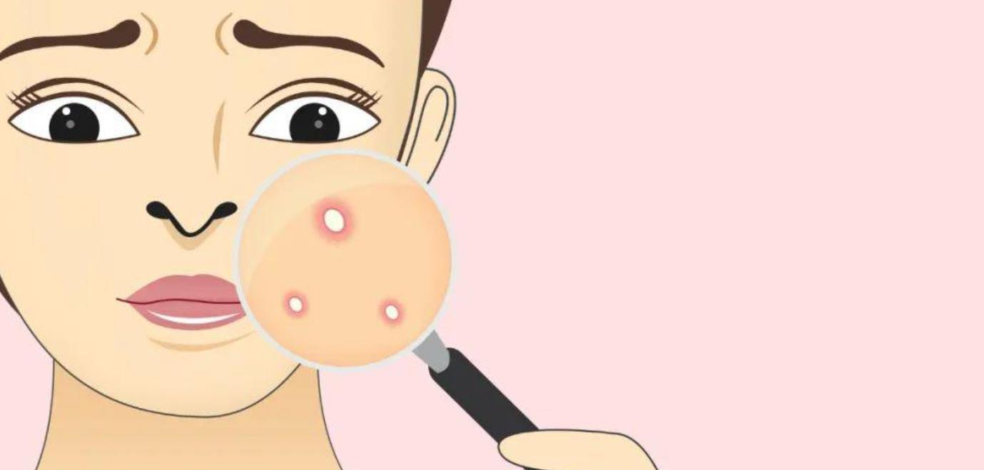 祛痘動漫h4.jpg 祛痘動漫h4.jpg