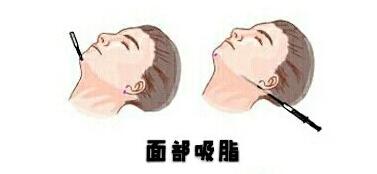 面部吸脂動漫03.jpg 面部吸脂動漫03.jpg