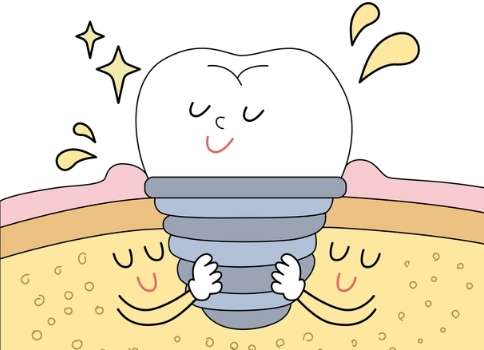 種牙植骨價格是多少？價格是在4000元到8萬元之間