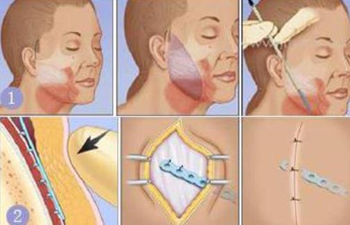 拉皮h0021.jpg 拉皮h0021.jpg