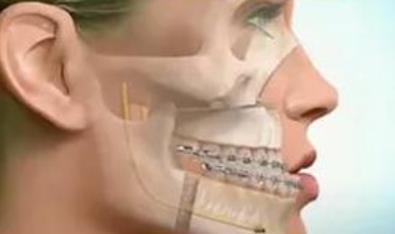 正頜手術(shù)h2.jpg 正頜手術(shù)h2.jpg