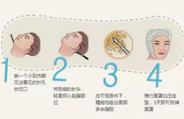 面部吸脂03.jpg 面部吸脂03.jpg