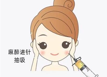 面部吸脂dm06.jpg 面部吸脂dm06.jpg