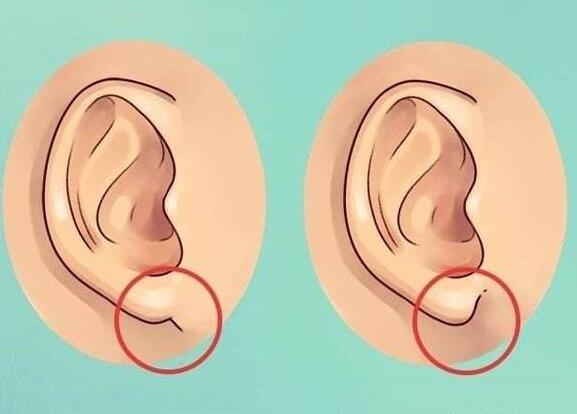 耳再造動(dòng)漫03.jpg 耳再造動(dòng)漫03.jpg