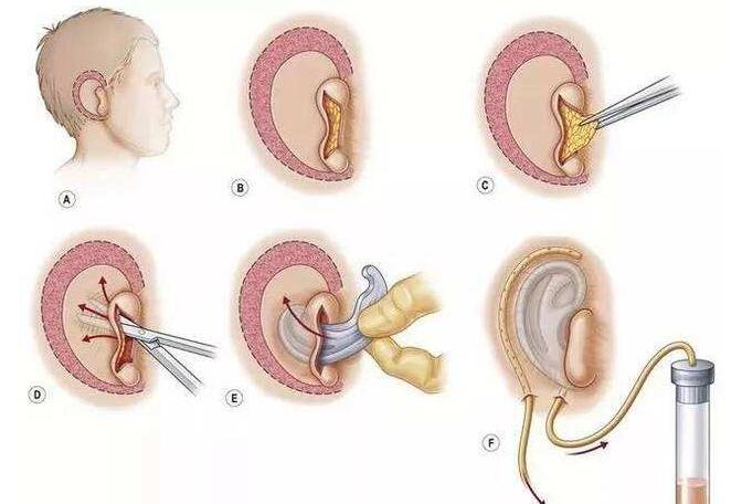 耳再造動(dòng)漫.jpg 耳再造動(dòng)漫.jpg