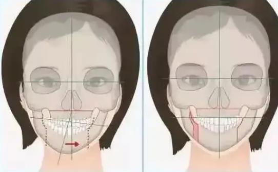 正頜手術(shù)h3.jpg 正頜手術(shù)h3.jpg