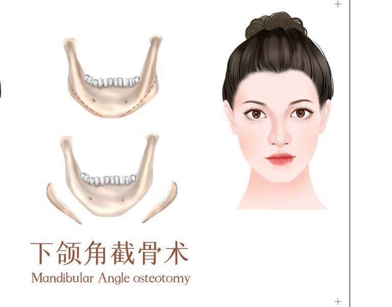 下頜角2.jpg