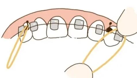 牙齒矯正動漫36.jpg 牙齒矯正動漫36.jpg