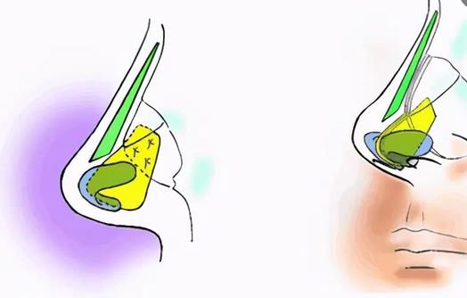 超肋骨鼻4.jpg 超肋骨鼻4.jpg